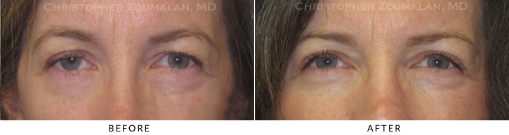 Upper Lid Blepharoplasty Before & After Photo -  - Patient 92