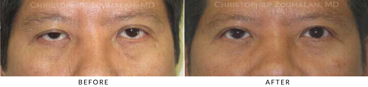 Upper Lid Blepharoplasty Before & After Photo -  - Patient 100