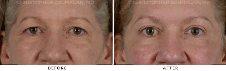 Upper Lid Blepharoplasty Before & After Photo - Patient Seeing Straight - Patient 23A
