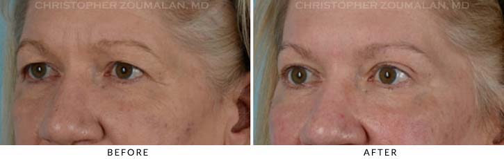 Upper Lid Blepharoplasty Before & After Photo - Patient Seeing Side - Patient 23B