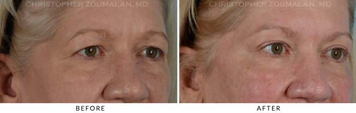 Upper Lid Blepharoplasty Before & After Photo - Patient Seeing Side - Patient 23C