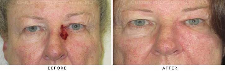 Eyelid Skin Cancer Excision Before & After Photo - Patient Seeing Straight - Patient 9