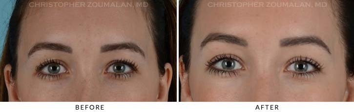 Upper Lid Blepharoplasty Before & After Photo - Patient Seeing Straight - Patient 24A