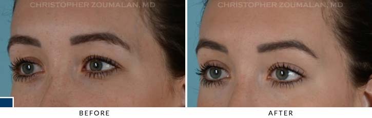 Upper Lid Blepharoplasty Before & After Photo - Patient Seeing Side - Patient 24B