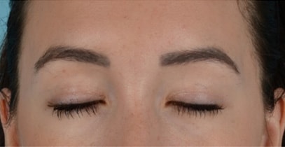 Upper Lid Blepharoplasty Before & After Photo - Patient with Eyes Closed - Patient 24C