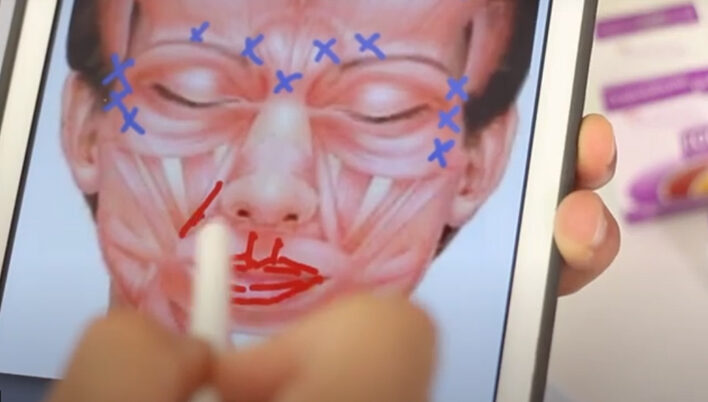 Dr. Zoumalan showing nasolabial filler placement and neuromodulator points on a facial anatomy chart