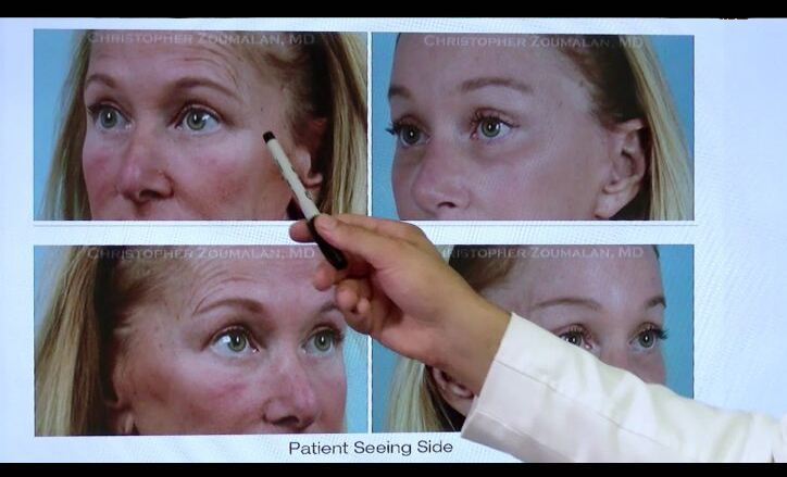 Laser Resurfacing procedure - Click to see video