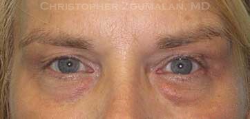 Combining Cosmetic Eyelid Fillers