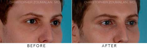 FILLERS TO TREAT LOWER EYELID HOLLOWING