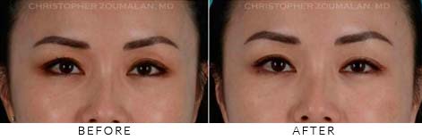 FILLERS TO UPPER LIDS