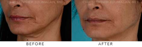 FILLERS FOR FACIAL REJUVENATION