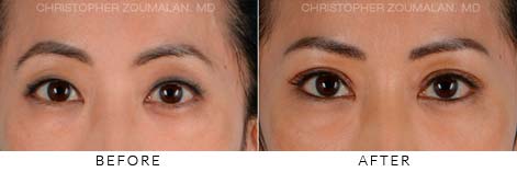 ASIAN EYELID (DOUBLE EYELID) SURGERY