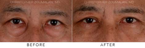 MALE BLEPHAROPLASTY