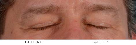 HOW DO EYELID SCARS HEAL