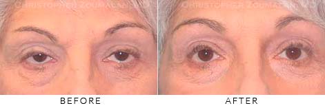 PTOSIS SURGERY