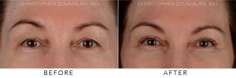 Upper Lid Blepharoplasty