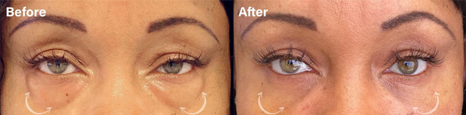 Lower eyelid Blepharoplasty before and after picture of a patient