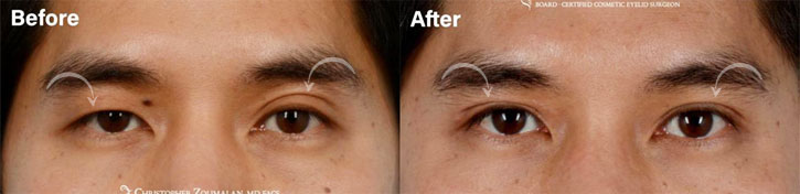 Before and after picture of male Asian eyelid surgery and mole removal