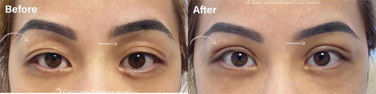 A beautiful asian eyelid surgery transformation - female patient before and after picture