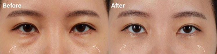 Beautiful lower eyelid blepharoplasty with fat repositioning result in a young female patient before and after picture