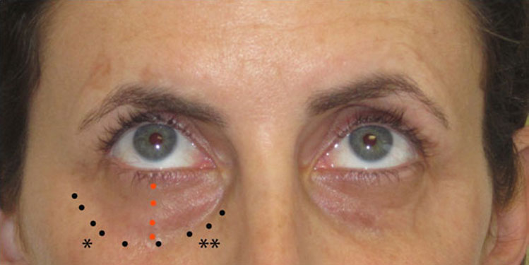 Volume loss appears as hollowing, which is usually seen along the infraorbital rim, which is the bone below the lower eyelids - female patient picture