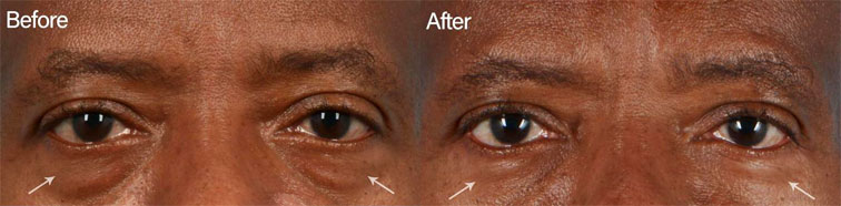 Prominent under eye fat pockets can be dramatically improved with an eyelid blepharoplasty procedure - male patient before and after picture