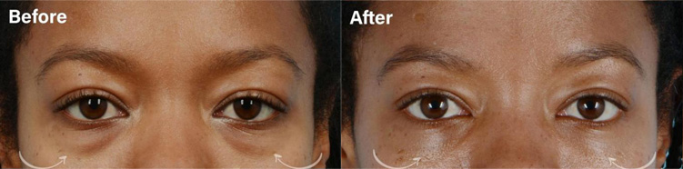 LOWER EYELID BLEPHAROPLASTY WITH FAT REPOSITIONING - female patient before and after picture