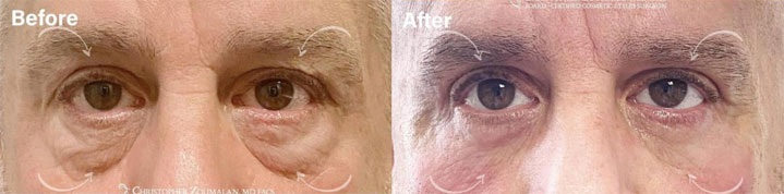 Male blepharoplasty should be tastefully done to preserve a masculine look, while rejuvenating the eyelids - male patient before and after picture
