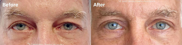 Beautiful male upper eyelid surgery and direct lateral brow lift to help restore symmetry and improve excess upper lid skin - male patient before and after picture