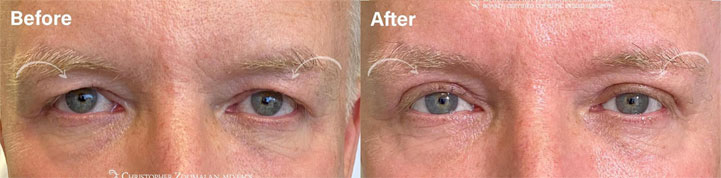 Beautiful male upper eyelid blepharoplasty to improve excess upper lid skin - male patient before and after picture