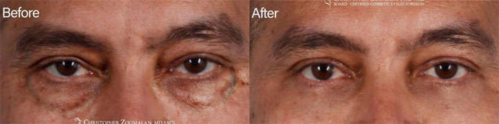 Beautiful and elegant Male Blepharoplasty, Minimal removal of upper eyelid skin and slight removal of his upper eyelid fat prominence - male patient before and after picture