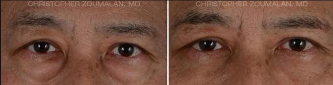 Lower eyelid blepharoplasty using Natural Looking Blepharoplasty Technique - male patient before and after picture