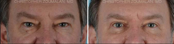 Upper and lower lid blepharoplasty using Natural Looking Blepharoplasty Technique - male patient before and after picture