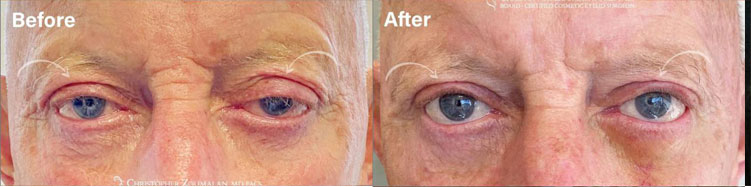 Before and after picture of ptosis surgery to improve droopy lids