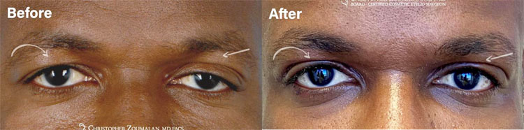 Before and after picture of an upper lid blepharoplasty and ptosis repair