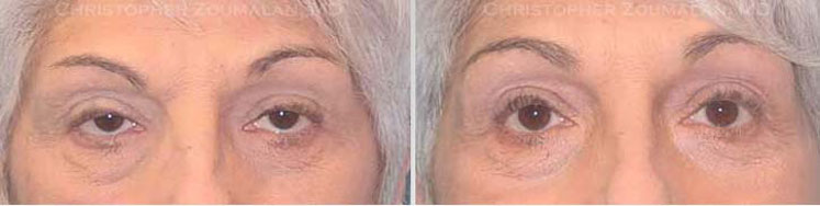 upper eyelid ptosis repair surgery - female patient before and after picture