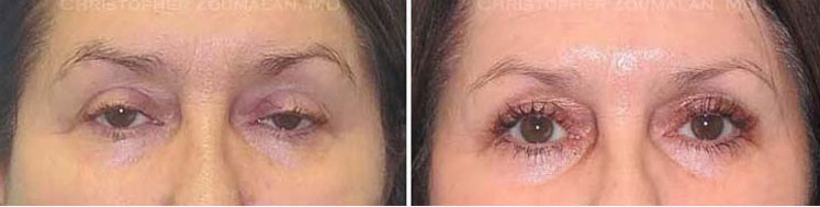 A minimally invasive ptosis repair (posterior approach) was performed to help elevate her lids and to allow her to see better - female patient before and after picture