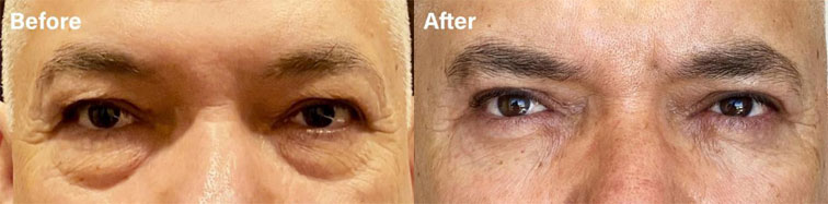 He had excess upper lid skin and under eye bags, and he underwent an upper and lower eyelid surgery. - male patient before and after picture