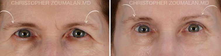 Tear trough hollow refers to hollowing along the eyelid closer to the nose - male patient before and after picture