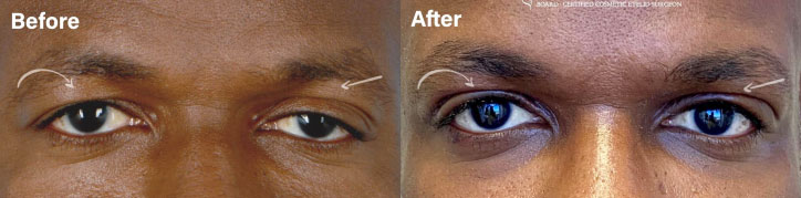 UPPER LID BLEPHAROPLASTY AND PTOSIS REPAIR - male patient before and after picture