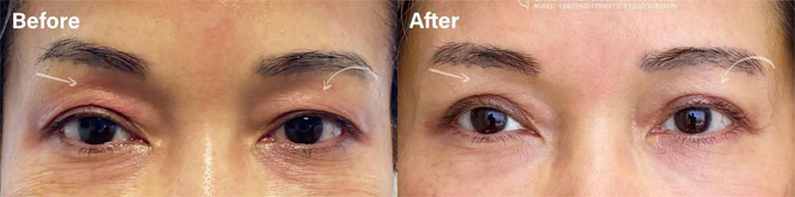 UPPER EYELID BLEPHAROPLASTY - female patient before and after picture