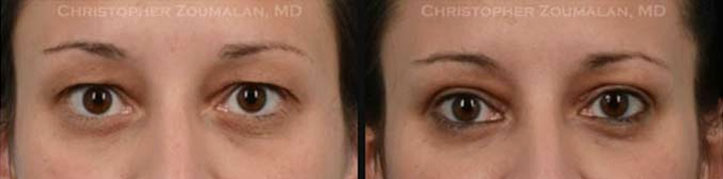 Completed upper eyelid blepharoplasty surgery to improve her appearance and enabled her peripheral vision to drastically increase. - female patient before and after picture