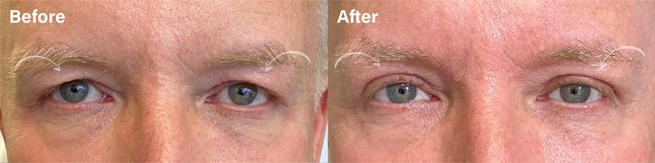 Beautiful MALE UPPER EYELID BLEPHAROPLASTY to improve excess upper lid skin. The excess skin is removed to help rejuvenate the eyes while preserving a natural look - male patient before and after picture