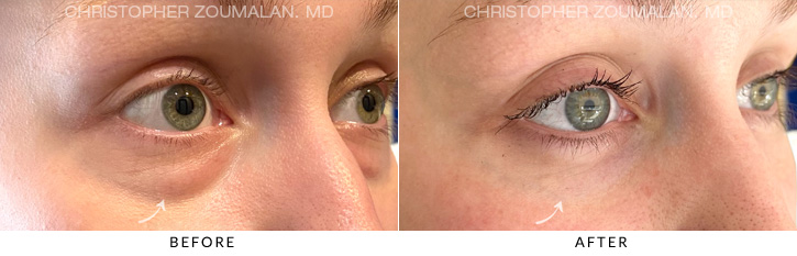Lower Lid Blepharoplasty Before & After Photo - Patient Seeing Side - Patient 5D