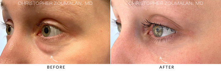 Lower Lid Blepharoplasty Before & After Photo - Patient Seeing Side - Patient 10C