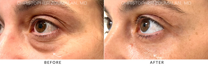 Lower Lid Blepharoplasty Before & After Photo - Patient Seeing Side - Patient 6C
