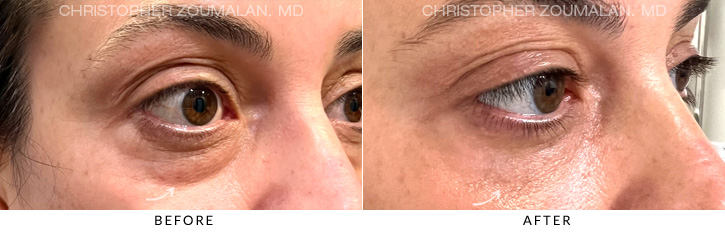 Lower Lid Blepharoplasty Before & After Photo - Patient Seeing Side - Patient 6D