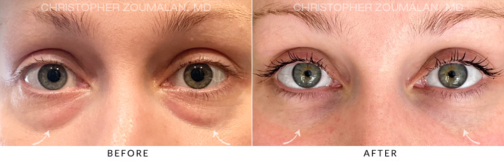 Lower Lid Blepharoplasty Before & After Photo - Patient Seeing Straight - Patient 10A