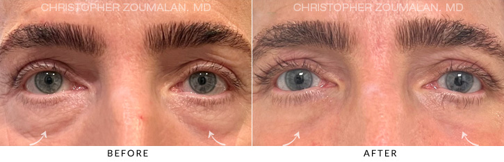 Lower Lid Blepharoplasty Before & After Photo - Patient Seeing Straight - Patient 9