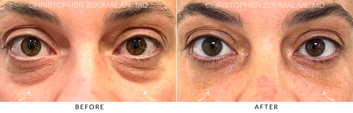 Lower Lid Blepharoplasty Before & After Photo - Patient Seeing Stright - Patient 6A